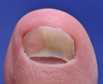 真菌,甲真菌病,趾甲,身体受伤,水平画幅,健康保健,丑陋,背景分离