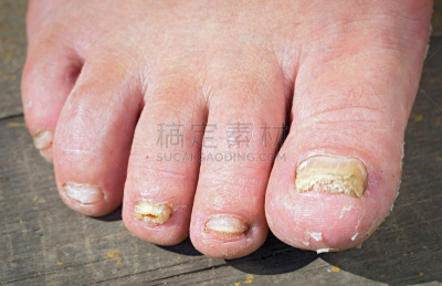 趾甲,真菌,足,男人,甲真菌病,毛木耳,癣菌,人类脚趾
