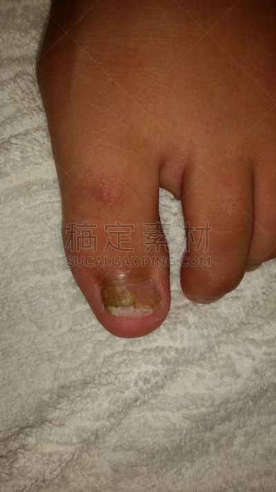 甲真菌病,脚气,真菌,趾甲,不舒服,人类脚趾,水平画幅,指甲,健康,特写