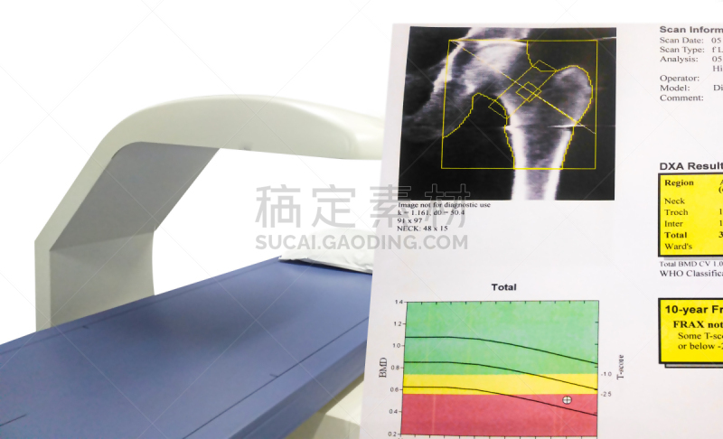 图像,骨质疏松症,骨密度,臀,决心,个性,充满的,结论,多孔渗水的