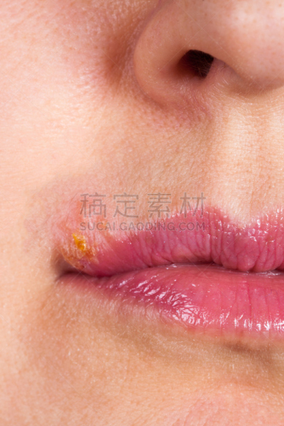 疱疹,嘴唇,特写,垂直画幅,轮峰菊,疱锈病真菌,多洛米蒂山脉,乌克兰,索乐,puerto de soller