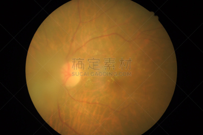 视网膜,糖尿病,健康保健,视网膜病,器官底部,角膜,室内管弦乐队,验光师,显微镜