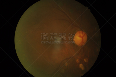 视网膜,糖尿病,健康保健,视网膜病,器官底部,角膜,室内管弦乐队,摄影,缺血,出血