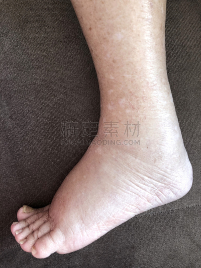 足,女性,悲痛,病人,垂直画幅,漏泄,白人,特写,仅成年人,部分