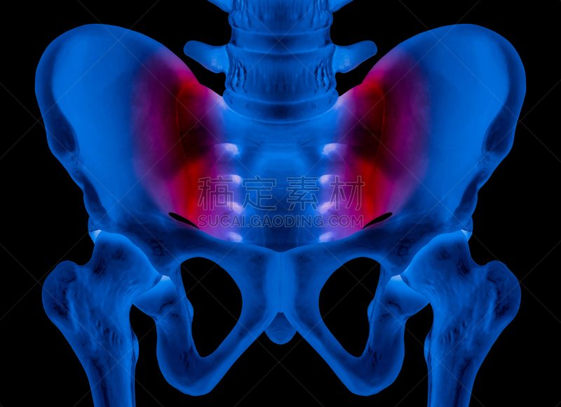 骨盆,痛苦,蓝色,人,健康保健,红色,关节,生物医学插图,x光