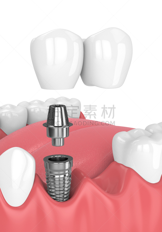 悬臂桥,三维图形,口腔卫生,垂直画幅,合成图像,人造的,牙冠,假牙,牙龈,二叶
