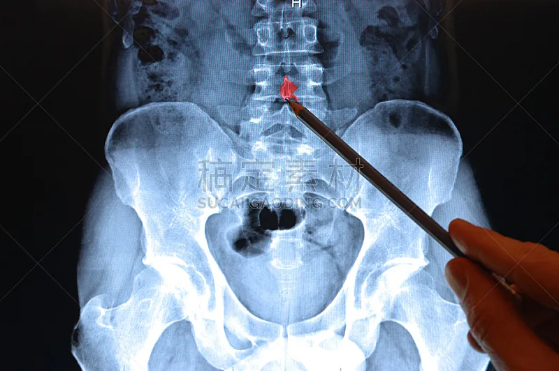 X光 腰骶部 骨关节炎 风湿病 骨质疏松症 胸腔 骨盆 骶区 英文字母x 关节炎图片素材下载 稿定素材