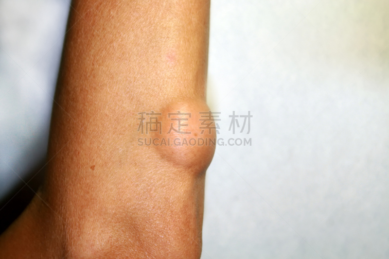 脂肪瘤,肘,血管纤维瘤,肿瘤,皮下的,瘀伤,皮肤病学,疤,水平画幅,缓慢的