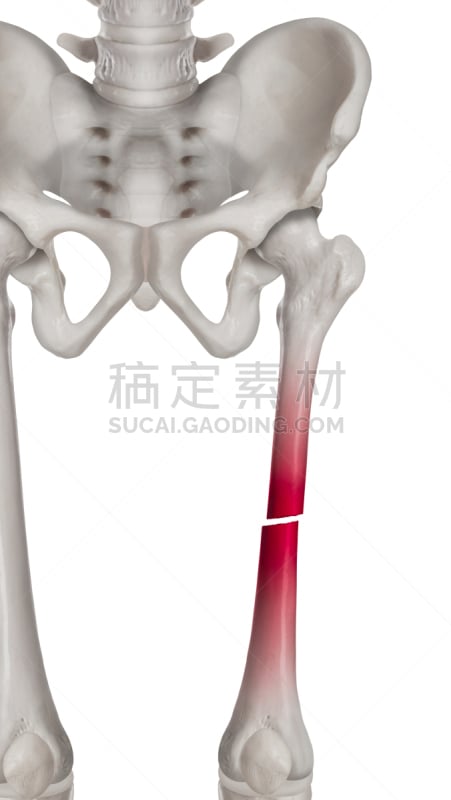 身体受伤,股骨,白色背景,健康保健,红色,荧光笔,分离着色,骨折,打字