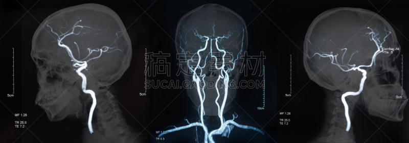 磁共振成象扫描,血管,脑,脑动脉,动脉瘤,mri扫描仪,动脉,cat扫描仪,超声波,医疗流程