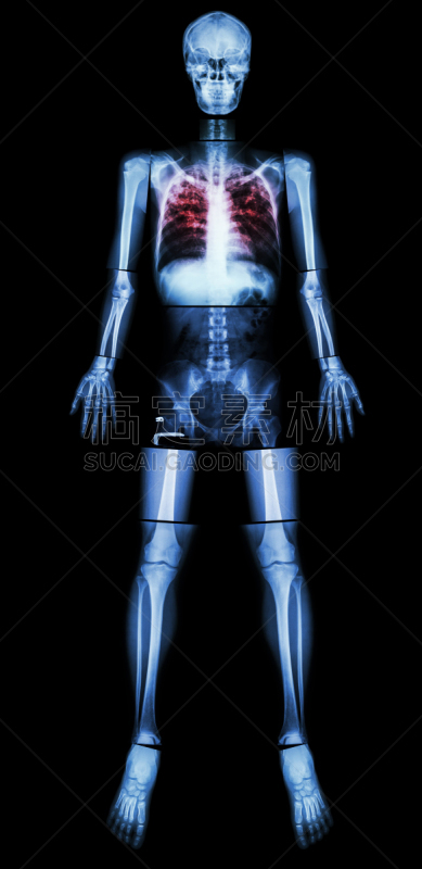 结核杆菌,人类肺脏,垂直画幅,正面视角,身体受伤,人类骨架,科学,呼吸系统,仅男人,仅成年人