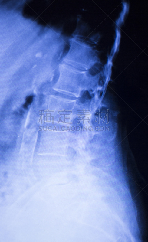 脊柱,后背,颈,医学扫描,x光,结论,整形器具,医学检测,成年的