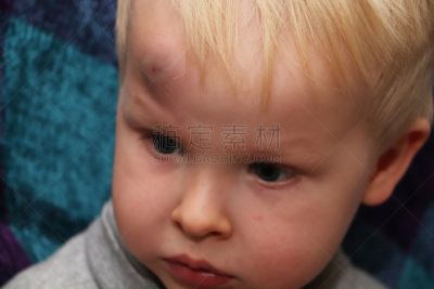 前额,瘀伤,男孩,巨大的,暴力,健康保健,被痛打的,药,拳头,儿童