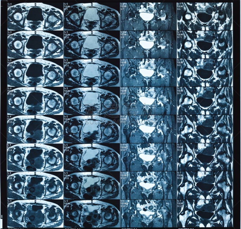 磁共振成象扫描,臀,雌性动物,身体受伤,人类骨架,股骨,水平画幅,科学,关节炎,实验室