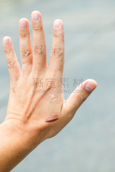 皮肤,手,疤,男人,瘢痕瘤,汽车,意外事件,修改系列,手腕,手术