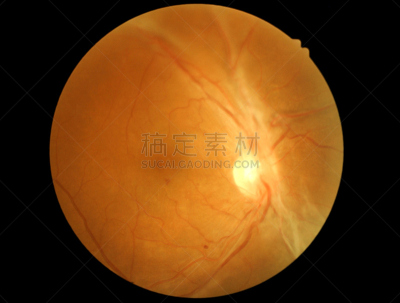 视网膜,糖尿病,美,闭塞,水平画幅,视神经,动物身体部位,叶脉,图像