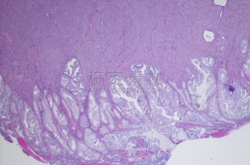 苏木素伊红染色,腺癌,字体,子宫内膜腺,子宫内膜异位,子宫内膜,大规模的放大,癌细胞,光显微图,显微镜载玻片