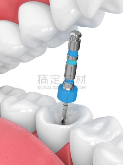 三维图形,牙齿,活页夹,口腔卫生,健康保健,珐琅,背景分离,牙髓学,牙医,医疗器械