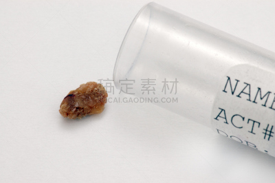 肾结石,状态,水平画幅,装管,无人,试管,健康保健,文字,医疗器械,影棚拍摄