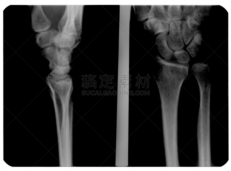 x光片,手,身体受伤,x光,四肢,水平画幅,医疗流程,健康保健