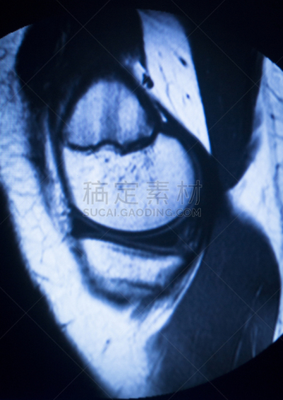 磁共振成象扫描,医学扫描,charles ray,股骨,mri扫描仪,韧带,膝,结论,医疗保险,垂直画幅