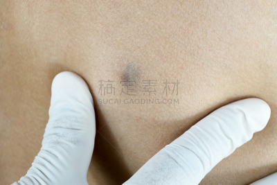 囊肿,后背,女人,速度滑冰,修改系列,皮脂腺,液囊,安逸,健康保健