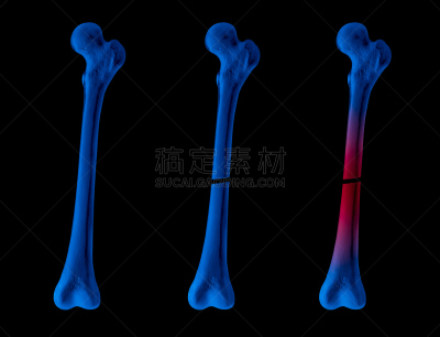 x光,骨骼,蓝色,健康保健,红色,字体,背景聚焦,骨折,收集