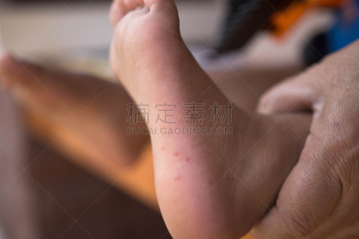 儿童,足,手,人的嘴,天花病毒,肠道孤病毒,水痘,疹,牛皮廯,脑炎