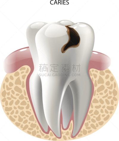 图像,人的牙齿,矢量,深的,人,健康保健,珐琅,牙医,脓肿