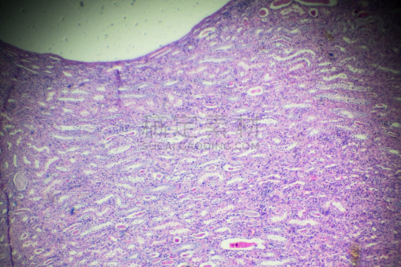 肾盂肾炎,放大效果,轻的,在下面,肾病,输尿管,多囊性卵巢综合症,肾元,人类肾脏,生理学