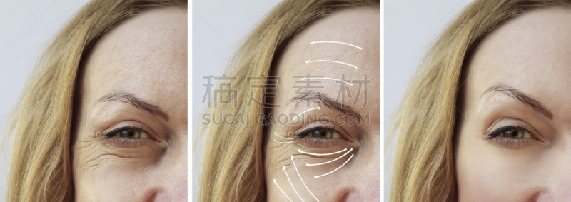 药,女人,箭头符号,皱纹,酸,活力,肿胀的,健康保健,中老年女人,塑胶