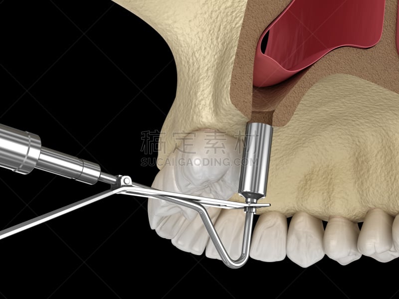 提举,骨骼,绘画插图,三维图形,窦,人造的,鼻窦,颌骨,健康保健,易接近性