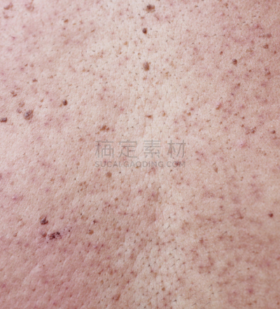 疤,后背,粉刺,问题,皮肤,女孩,垂直画幅,美,青少年,spa美容