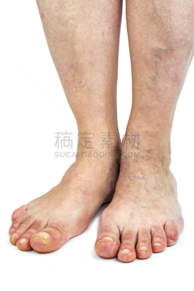 静脉曲张,蛛状静脉曲张,血凝结,肿胀的,腰部以下,垂直画幅,四肢,腿,白人