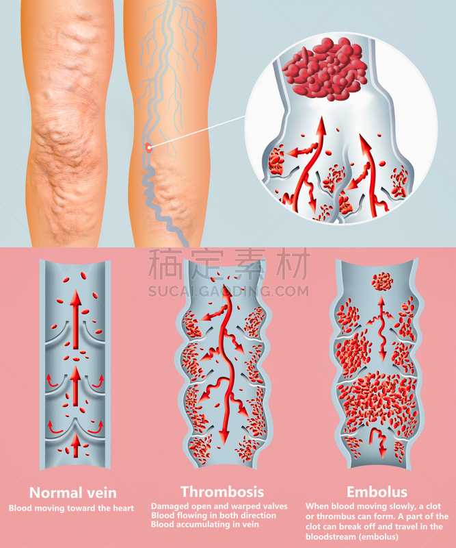 血凝结,血栓症,成年的,仅成年人,老年人,心血管系统,冠状动脉,人类心脏