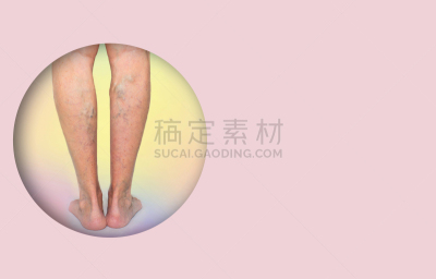 女性,腿,静脉曲张,手,四肢,平滑的,成年的,身体保养,仅一个女人