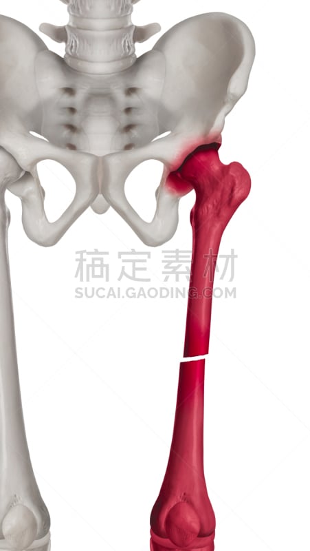 股骨,痛苦,白色背景,健康保健,红色,生物医学插图,荧光笔,腿骨,动物腿,骨折