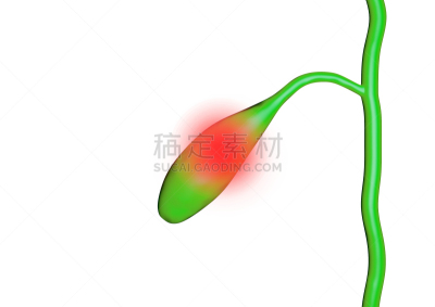 胆囊,三维图形,巨大的,石头,导管,膀胱,人类消化系统,胆汁
