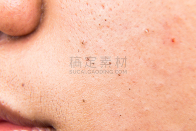 青少年,特写,人的脸部,粉刺,斑点,美,青春期,水平画幅,疤,脸颊