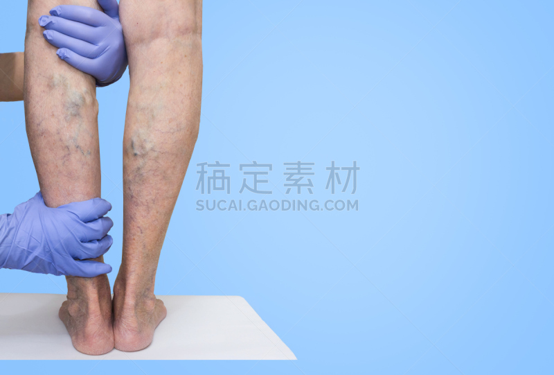 腰部以下,四肢,肿胀的,安逸,健康保健,空的,背景分离,一个人,蛛状静脉曲张