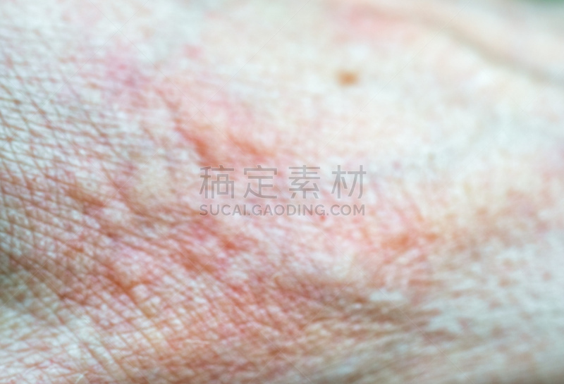 水泡,特写,纹理,皮肤,特应性湿疹,疱疹,allergic vasculitis,表皮细胞,牛皮廯,带状疱疹