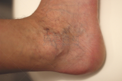 体毛,静脉曲张,维管束,肿胀的,皮肤状况,选择对焦,留白,四肢,水平画幅