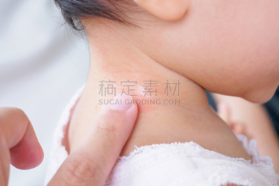 母亲,颈,婴儿,蚊叮咬,皮疹,替代疗法,辅导讲座,水平画幅,疤,男婴