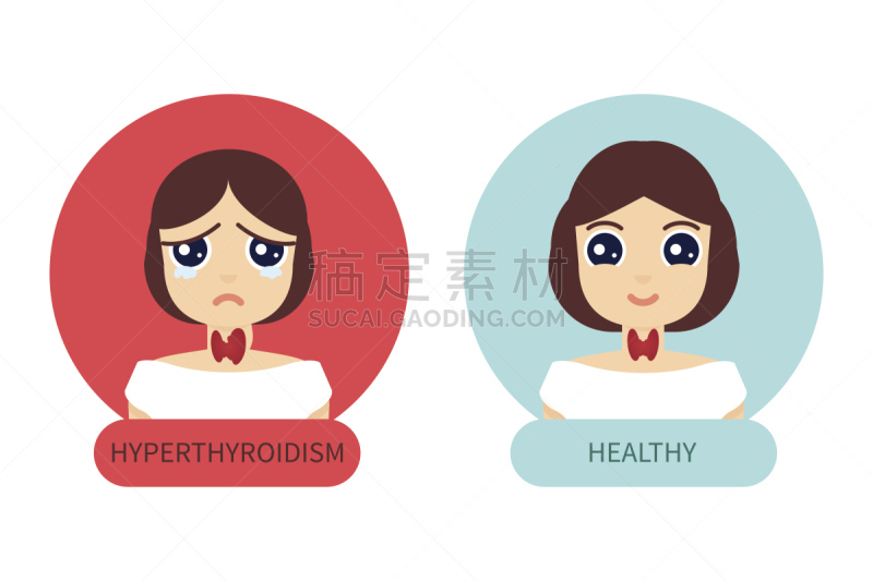 人类腺体,女人,甲状腺,甲亢,分泌细胞,内分泌系统,喉,气管,软骨,颈