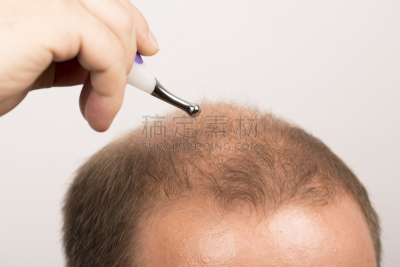 男人,发际线后移,秃头症,头皮,水平画幅,情绪压力,维生素,白人,特写,活力