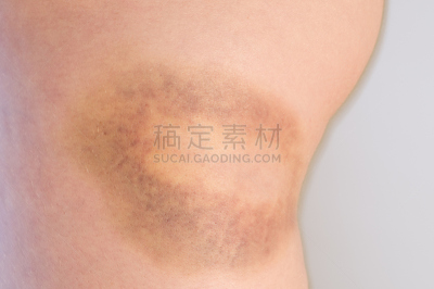水平画幅,瘀伤,大腿,女人,四肢,仅一个女人,点状,人,腿