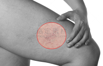 皮肤,腿,小的,血管,举起手,男人,座位,毛细血管床,微静脉,蛛状静脉曲张