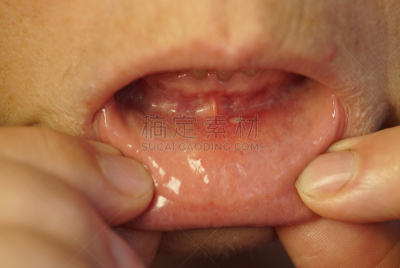 人的嘴,特写,水泡性口炎,嘴唇,腰部以下,身体受伤,水平画幅,唾液,仅成年人