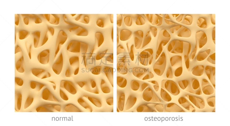 骨质疏松症,修改系列,多孔渗水的,洞,水平画幅,纹理效果,形状,绘画插图,特写,部分