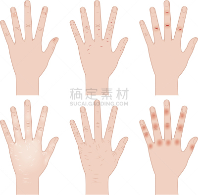 手,粗糙的,手背,冻疮,真皮层,人类肌肉,坏掉的,绘画插图,痛苦